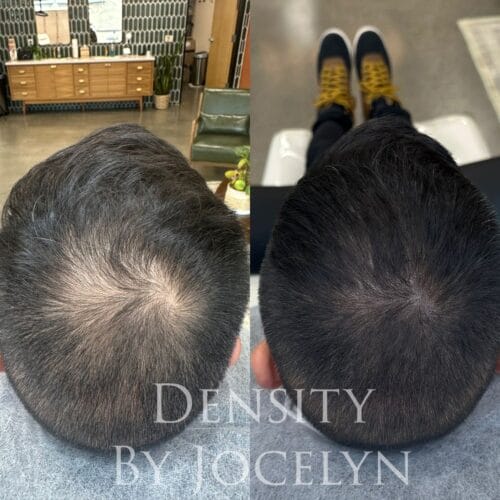 SMP for Hair Density at DAELA