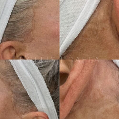 Camouflage Facelift Scarring at DAELA Scottsdale