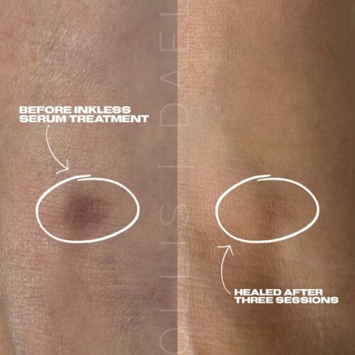 Scar Camouflage Tattoo in Scottsdale at DAELA