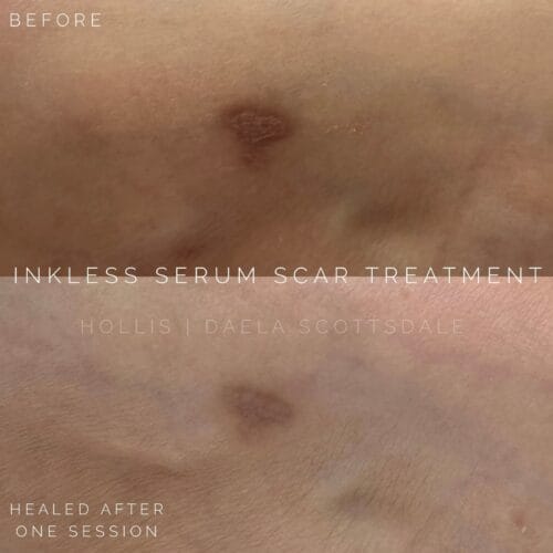 Scar Serum Treatment in Scottsdale at DAELA