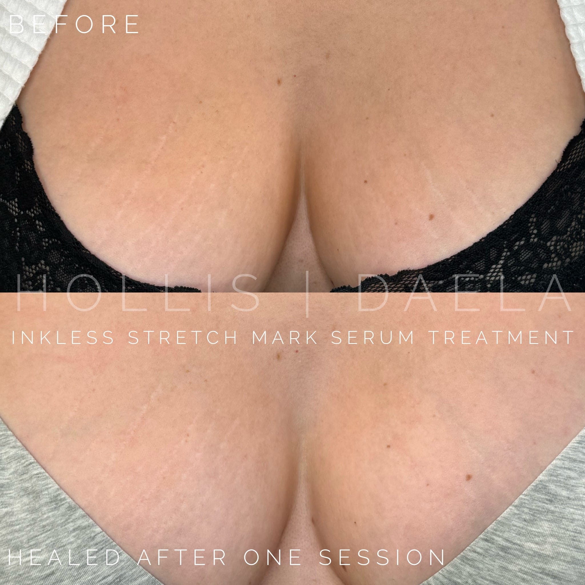 stretch-mark-camouflage-in-scottsdale stretch mark camouflage tattoo in scottsdale at daela scottsdale