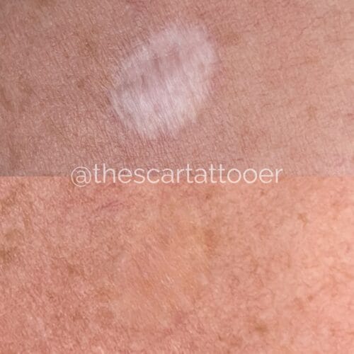 Scar Camouflage Tattoo DAELA Cosmetic Tattoo Portland-Shonna