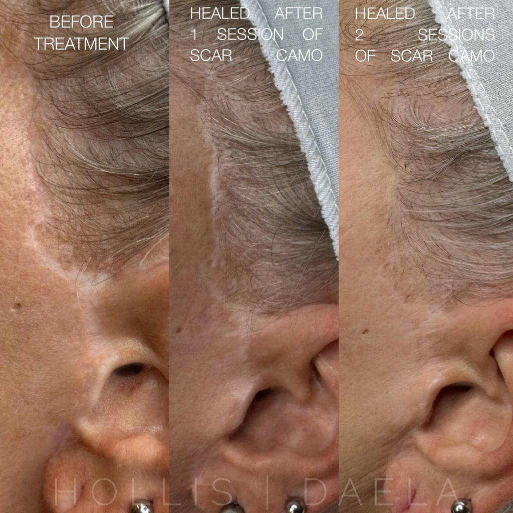 Paramedical Tattoo at DAELA Cosmetic Tattoo