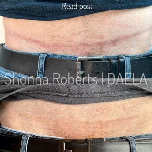 Scar Camouflage Tattoo by Shonna at DAELA Cosmetic Tattoo