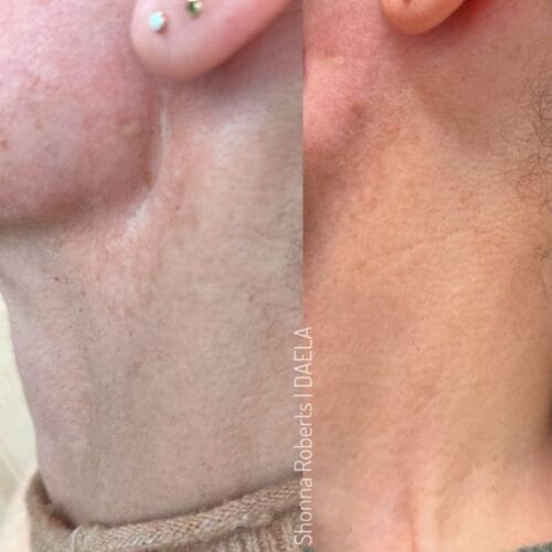 Scar Camouflage Tattoo by Shonna at DAELA Cosmetic Tattoo