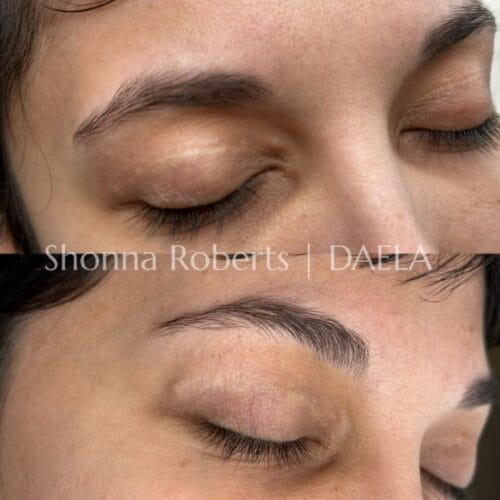 Scar Camouflage Tattoo by Shonna at DAELA Cosmetic Tattoo