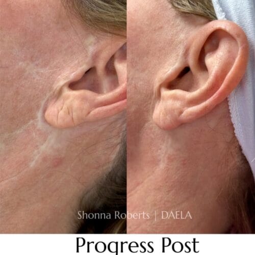 Scar Camouflage Tattoo by Shonna at DAELA Cosmetic Tattoo