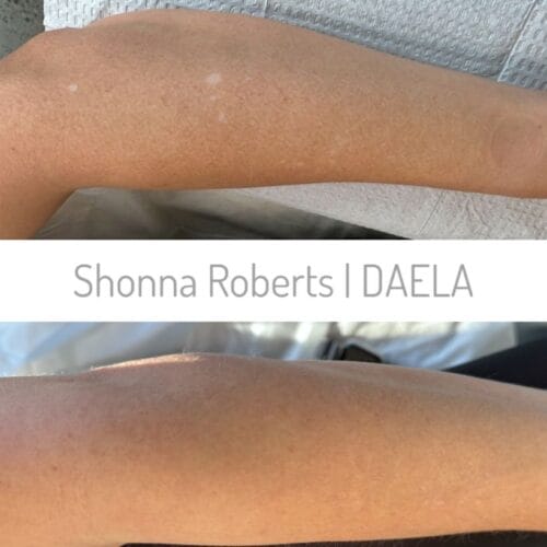 Scar Camouflage Tattoo by Shonna at DAELA Cosmetic Tattoo