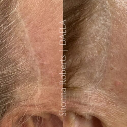 Scar Camouflage Tattoo by Shonna at DAELA Cosmetic Tattoo