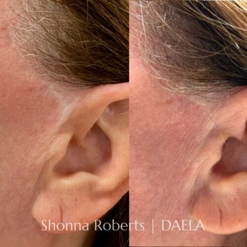 Scar Camouflage Tattoo by Shonna at DAELA Cosmetic Tattoo