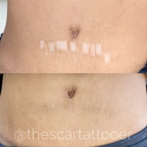 Radiation Marker Camouflage DAELA Cosmetic Tattoo