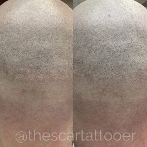 FUE and FUT scar camouflage tattoo DAELA Cosmetic Tattoo