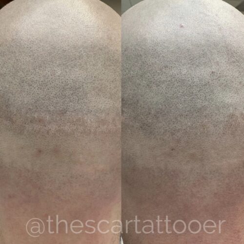 Scar Camouflage FUT and FUE scars vancouver daela shonna