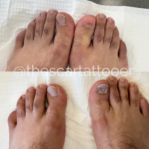Toenail Scar Camouflage Tattoo Vancouver DAELA Shonna