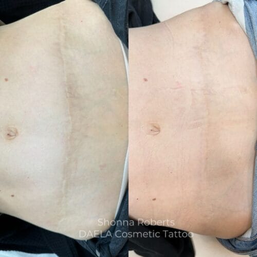 Scar Camouflage Tattoo by Shonna at DAELA Cosmetic Tattoo