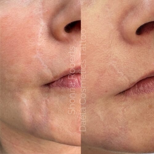 Scar Camouflage Tattoo Portland DAELA by Shonna