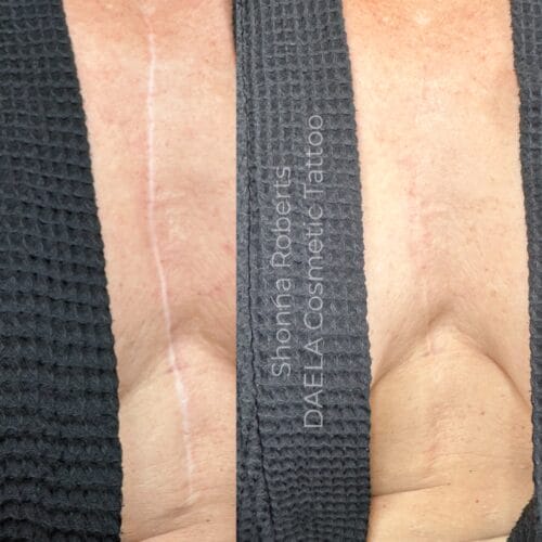 Scar Camouflage Tattoo Portland DAELA by Shonna