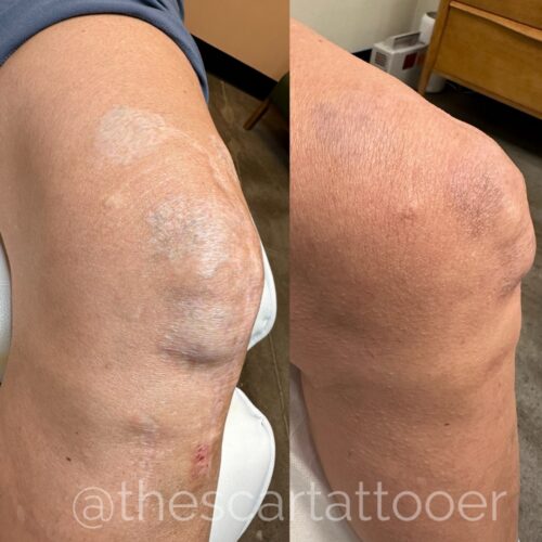 Scar Camouflage Tattoo Vancouver DAELA Shonna