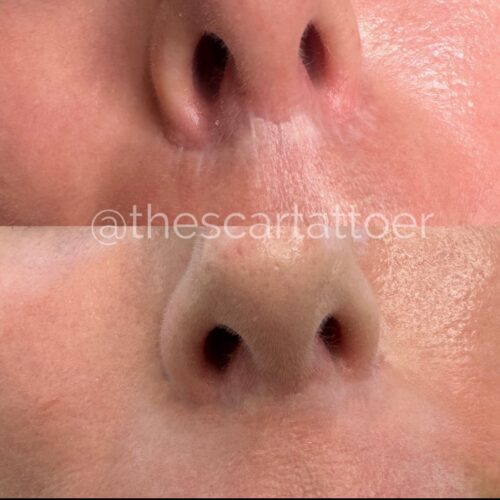 Scar Camouflage Tattoo Vancouver DAELA Shonna