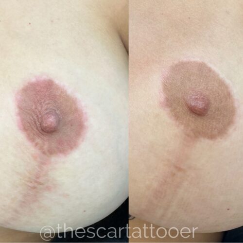 Scar Camouflage Tattoo Vancouver DAELA Shonna