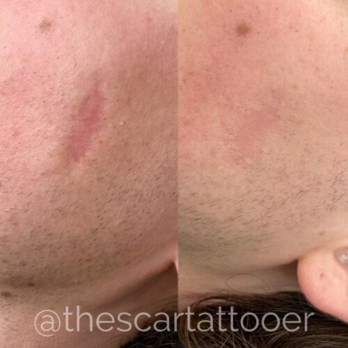 Scar Camouflage Tattoo Vancouver DAELA Shonna