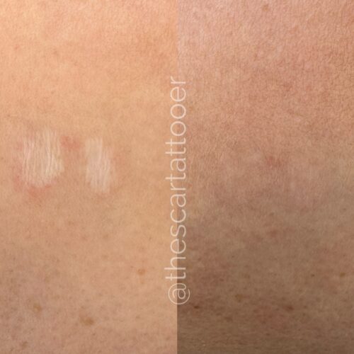 Scar Camouflage Tattoo Vancouver DAELA Shonna