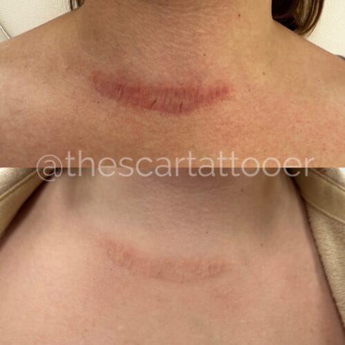 Scar Camouflage Portland DAELA Shonna