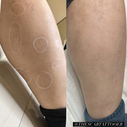 Scar camouflage tattoo by Shonna at DAELA Cosmetic Tattoo