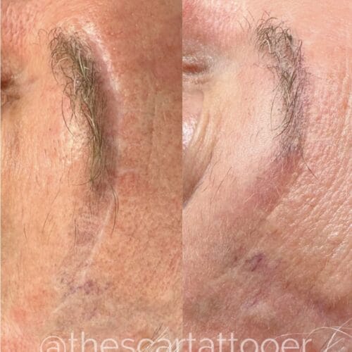 Scar Camouflage Tattoo by Shonna at DAELA Cosmetic Tattoo