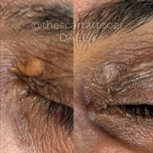 Eyelid Scar Camo in Portland Oregon