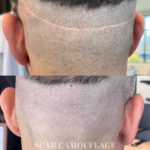 Comprehensive Guide to Scalp Micropigmentation: SMP for Hair Transplant Scars at DAELA