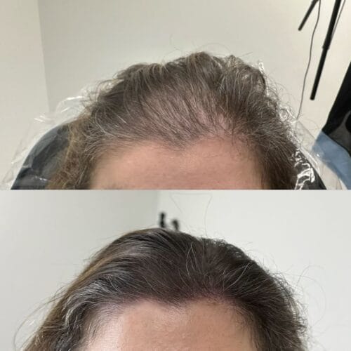 Scalp Micropigmentation Density for Women at DAELA Cosmetic Tattoo