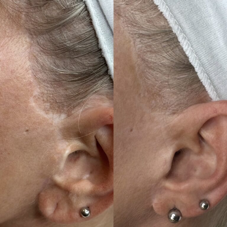 Scar Camouflage Tattoo in Scottsdale at DAELA Cosmetic Tattoo