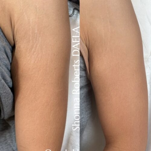 Stretch Mark Camouflage Portland DAELA