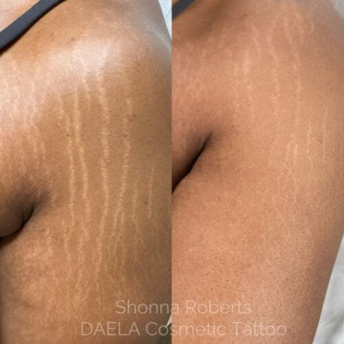 Stretch Mark Treatment Portland DAELA by Shonna