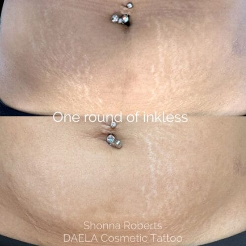 Stretch Mark Treatment Portland DAELA by Shonna