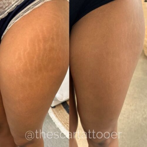 Stretch Mark Treatments Vancouver DAELA Shonna