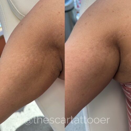Stretch Mark Treatments Vancouver DAELA Shonna