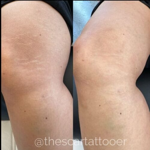 Stretch Mark Treatment Portland DAELA Cosmetic Tattoo Shonna