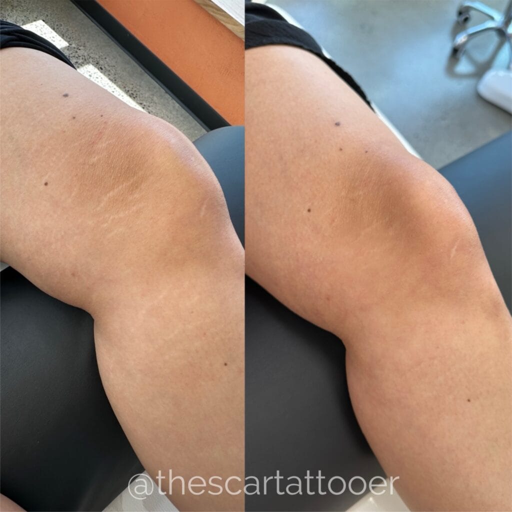 stretch mark treatments