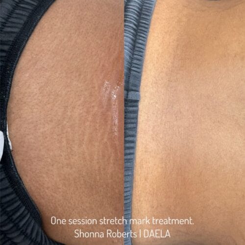 Stretch Mark Treatment Portland DAELA Cosmetic Tattoo Shonna