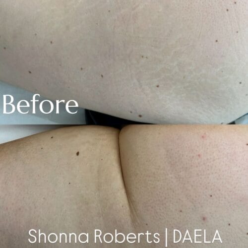 Stretch Mark Treatment Portland DAELA Cosmetic Tattoo Shonna