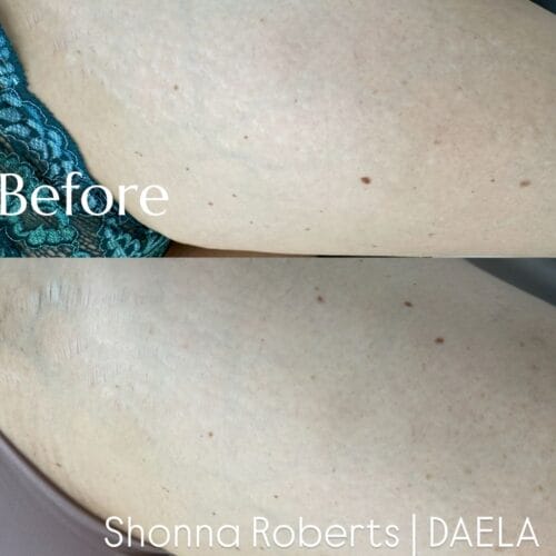 Stretch Mark Treatment Portland DAELA Cosmetic Tattoo Shonna