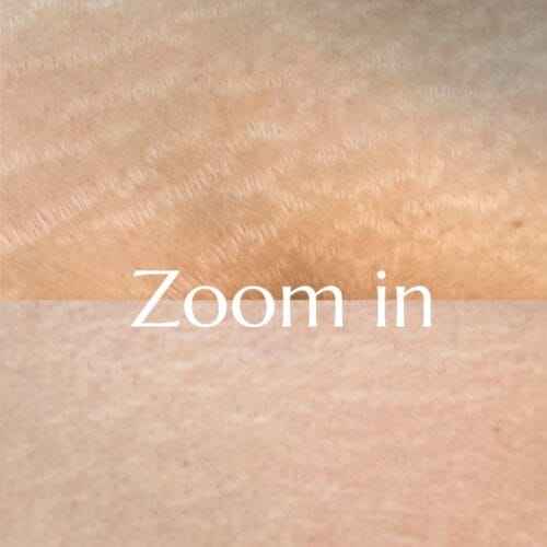 Stretch Mark Treatment Portland DAELA Cosmetic Tattoo Shonna