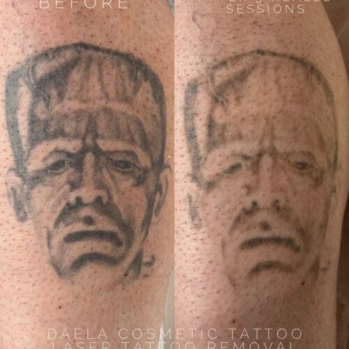 Laser Tattoo Removal Portland Oregon at DAELA