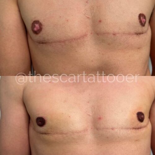 Top Surgery Scar Camouflage Tattoo Vancouver DAELA Shonna