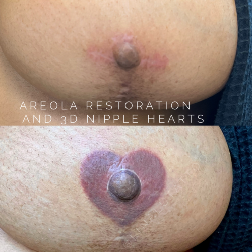 Areola Restoration Tattoo Vancouver DAELA Lina
