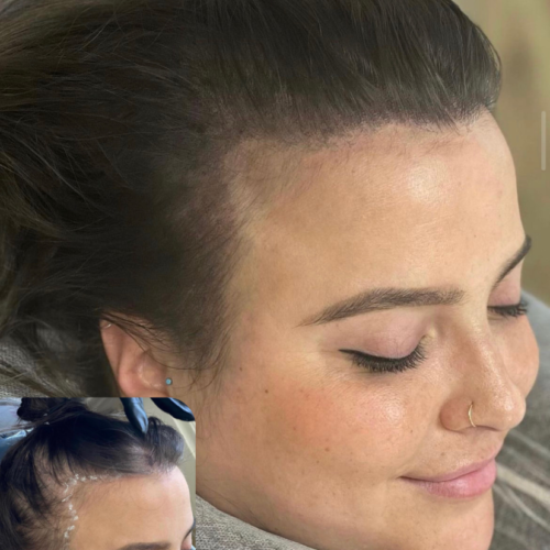 Scalp Micropigmentation Density for Women at DAELA Cosmetic Tattoo