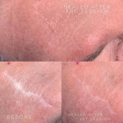 Scar Camouflage Tattoo Vancouver DAELA Shonna