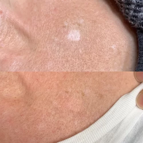 Scar Camouflage Tattoo Vancouver DAELA Shonna